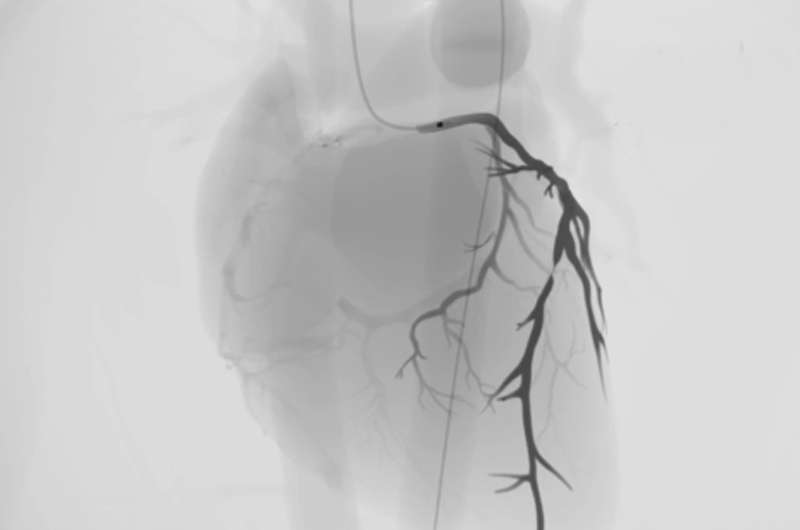 occlusion angiogram